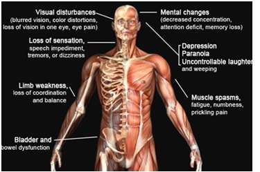 global-multiple-sclerosis-market