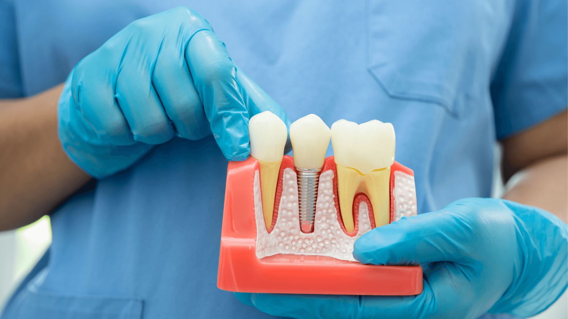 Top Dental Implant Companies